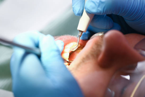 Best Emergency Dentist for Lost Fillings or Crowns in Lake Monticello, VA